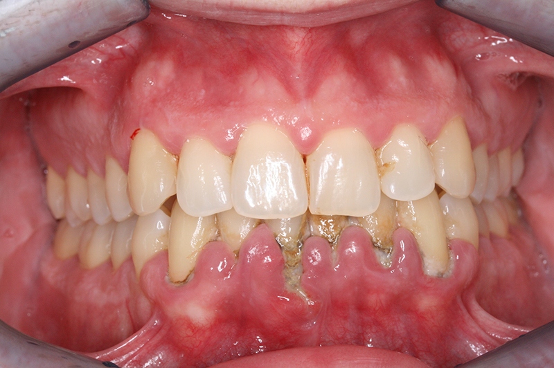 Cirugia Periodontal abril 2010