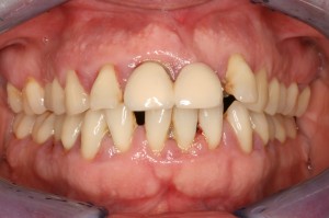 tratamiento periodontal