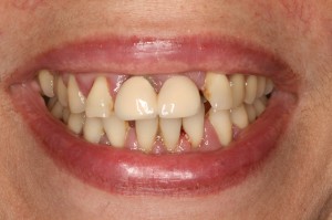 tratamiento periodontal antes