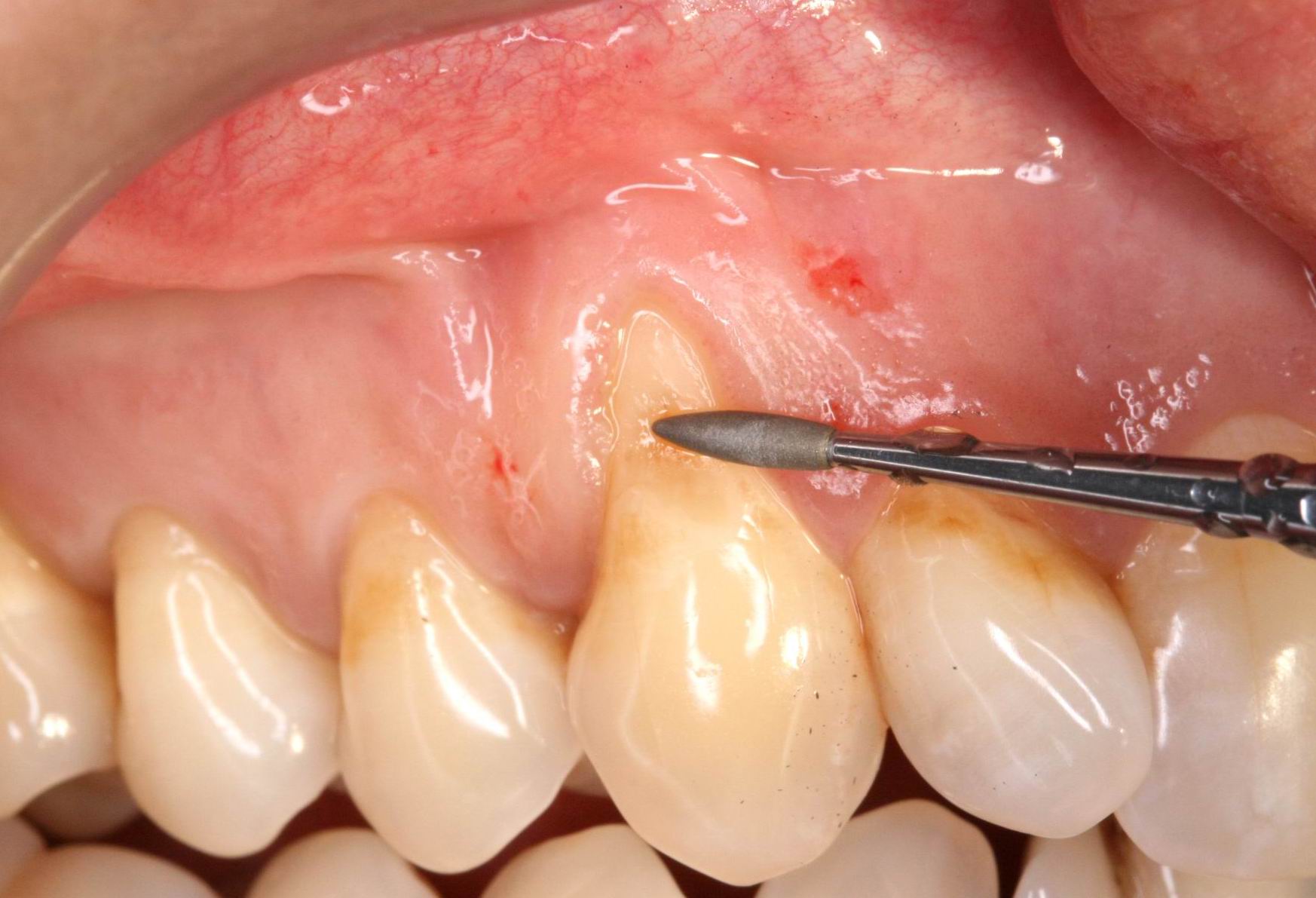 Cirugía de tejidos blandos alrededor de dientes e implantes